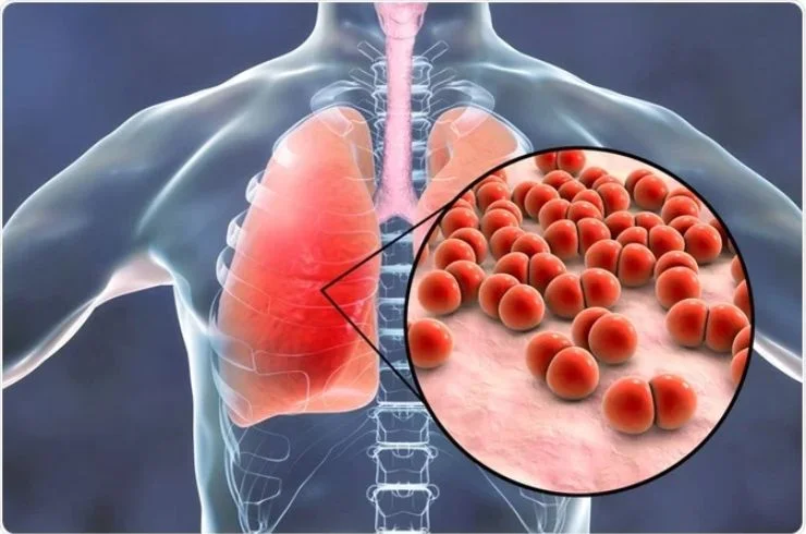 TREATMENT OF PNEUMONIA & OTHER DISEASES---4